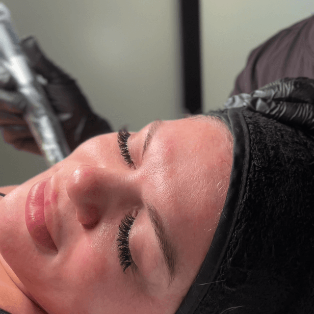 Microneedling (3 Sessions) at SKN Med Spa in Delray Beach, FL