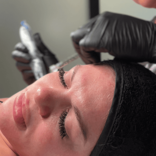 Microneedling (6 Sessions) at SKN Med Spa in Delray Beach, FL